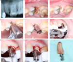 Revlis Atraumatic Root tooth Extraction System Dental Atraumatic - Image 2
